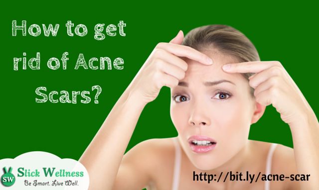 How to get rid of Acne Scars?