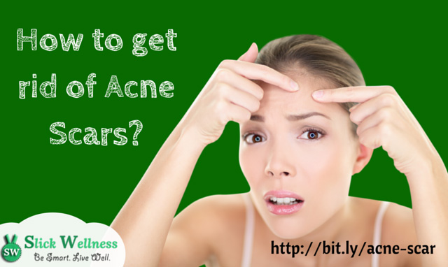 How to get rid of Acne Scars? 1 How to get rid of Acne Scars?