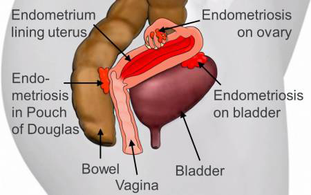 Why am I not getting pregnant? 11 Possible reasons you shouldn’t ignore 6 Endometriosis
