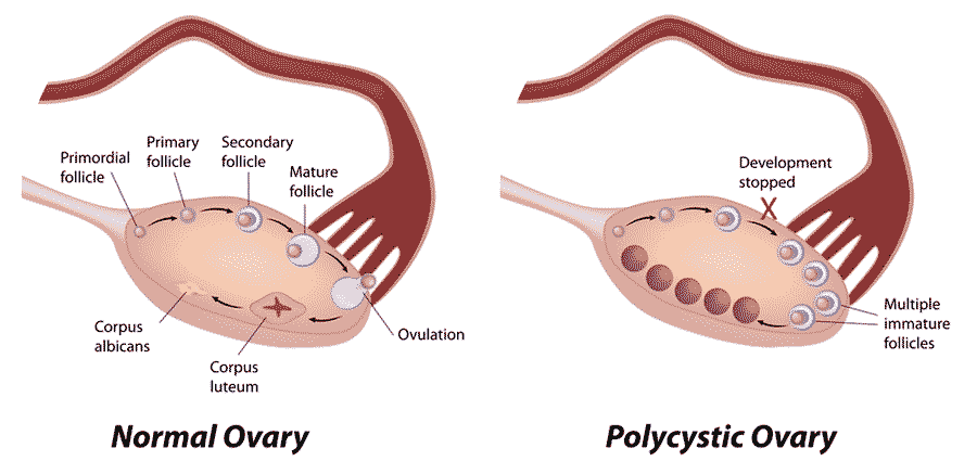 Why am I not getting pregnant? 11 Possible reasons you shouldn’t ignore 5 PCOS illustration