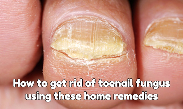 Get rid of toenail fungus - Simple home remedies