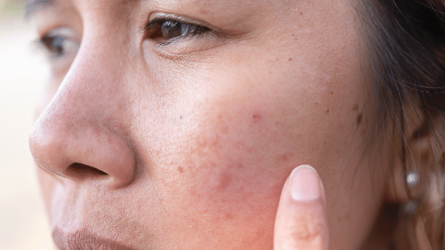 What is hormonal imbalance and what are its symptoms? 4 Skin issues