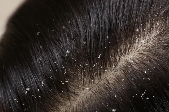 Dandruff Care Guide